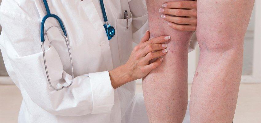 Uma em cada quatro pessoas morre de trombose